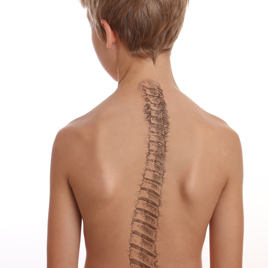 If lower #backpain persists or a child shows 'favoring behavior' while competing, consider these conditions: Scheuermann’s disorder, isthmic spondylolysis, and degenerative disc disease with or without disc herniation. Early diagnosis is key! medilink.us/wry3  #SpineHealth