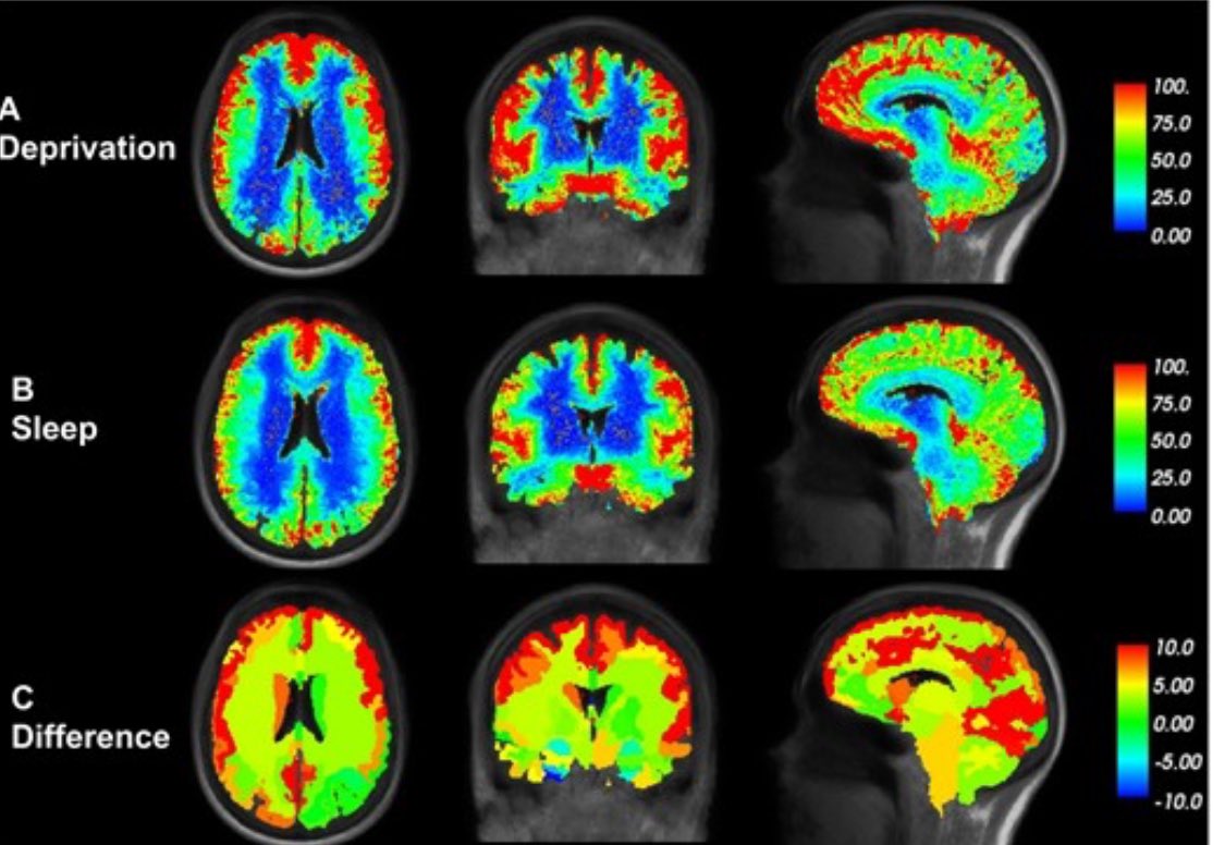 Yetersiz uyku, beyindeki atık temizleme mekanizmasını yavaşlatır. Beyinde birtakım toksik atıkların birikmesine neden olur. Bu atıklar, alzheimer hastalığı gibi sinir hasarı ile ilişkili hastalıklarda biriken türden atıklardır.

Uyku sadece dinlenmeye yaramaz, çok daha önemlidir.