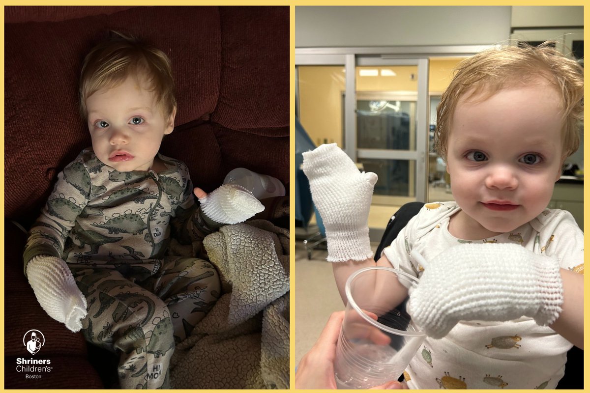Walker came to @ShrinersBoston when he sustained burns to both hands after touching a pellet stove. His mother is spreading an important safety message & hopes her family’s experience will be educational for others. ow.ly/rG7E50Rh5ci

#ShrinersChildrens #BurnCare