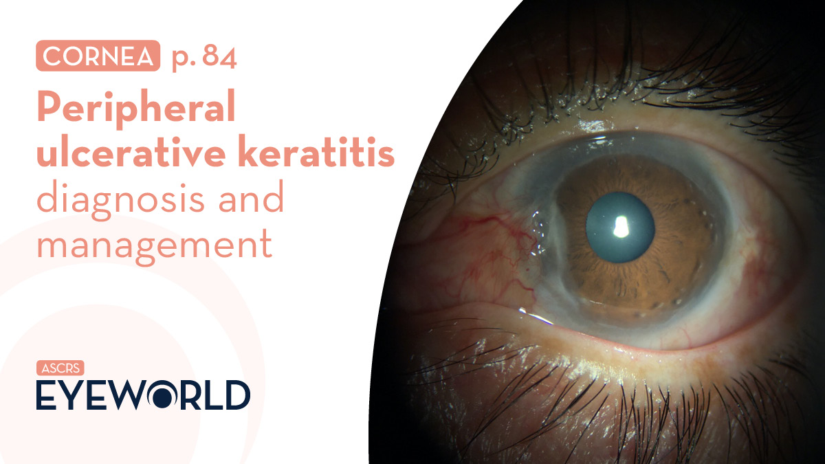 Learn about diagnosis and management of peripheral ulcerative keratitis from Ashraf Ahmad, MD, and Sanjay Kedhar, MD, in #EyeWorldMagazine bit.ly/3VqEUhO