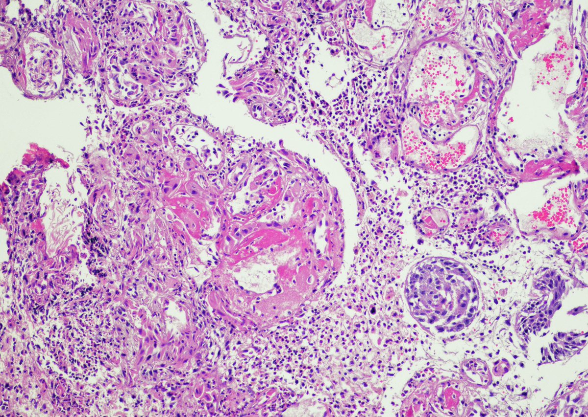 Pathoutlines's tweet photo. Image Quiz! A 68-year-old man presented with hematuria and dysuria. He has a medical history of prostate cancer that was treated with radiation therapy. Cystoscopy revealed hemorrhage in the right bladder wall. (Cont. below)
#ImageQuiz #PathTwitter #PathologyOutlines #Diagnosis https://t.co/x7Ns396Iwq