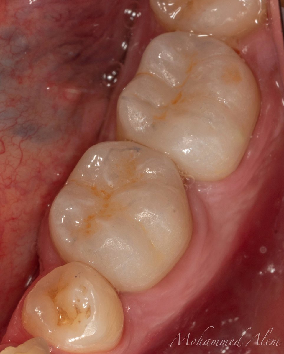 إعادة ترميم لضرسين…
Re-RCT, Fiber post and core build up, Prep and temp, Crown lengthening then finally Zirconia Crowns for #37, #36 !