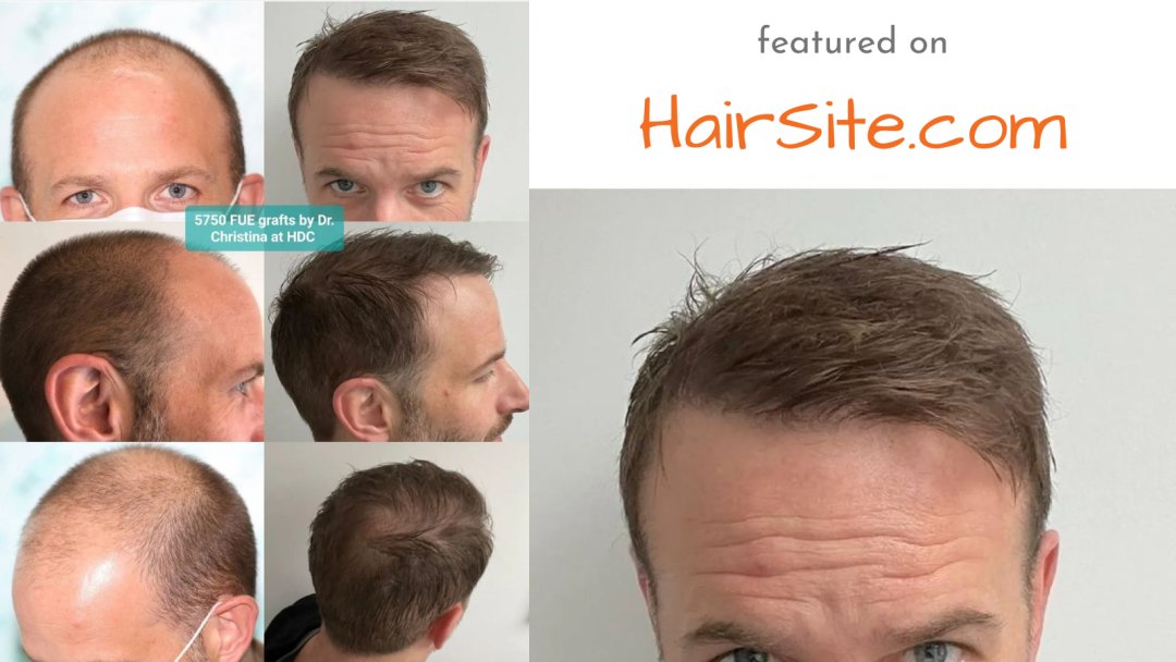 HairSite's tweet photo. sponsored - HDC clinic 5750 grafts hair transplant. Click https://t.co/C0Pgiaaoo8 for free consultation &amp;cost estimates with up to 20 clinics worldwide.  

#MAGACult #Melania #Cardoso #Raven #Boeing $SCHRO #BitcoinHalving2024 #TOTNFO #ShuChe #THFC #weareoneEXO #solar #JONGHYUN https://t.co/uuJhGVgfQx