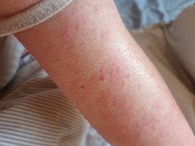 Has anyone taken a potassium supplement and then become allergic to bananas!? This is my 3rd severe allergy<a href="/tag/throne"class="tags"><span>#throne</span></a><a href="/tag/wishlist"class="tags"><span>#wishlist</span></a>