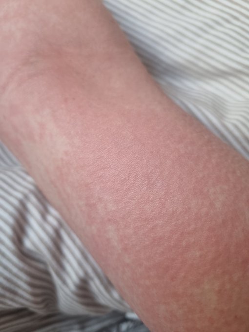 Has anyone taken a potassium supplement and then become allergic to bananas!? This is my 3rd severe allergy<a href="/tag/throne"class="tags"><span>#throne</span></a><a href="/tag/wishlist"class="tags"><span>#wishlist</span></a>