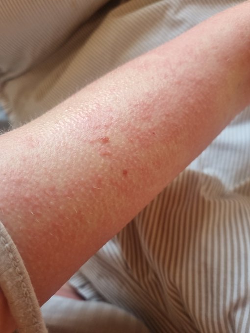 Has anyone taken a potassium supplement and then become allergic to bananas!? This is my 3rd severe allergy<a href="/tag/throne"class="tags"><span>#throne</span></a><a href="/tag/wishlist"class="tags"><span>#wishlist</span></a>