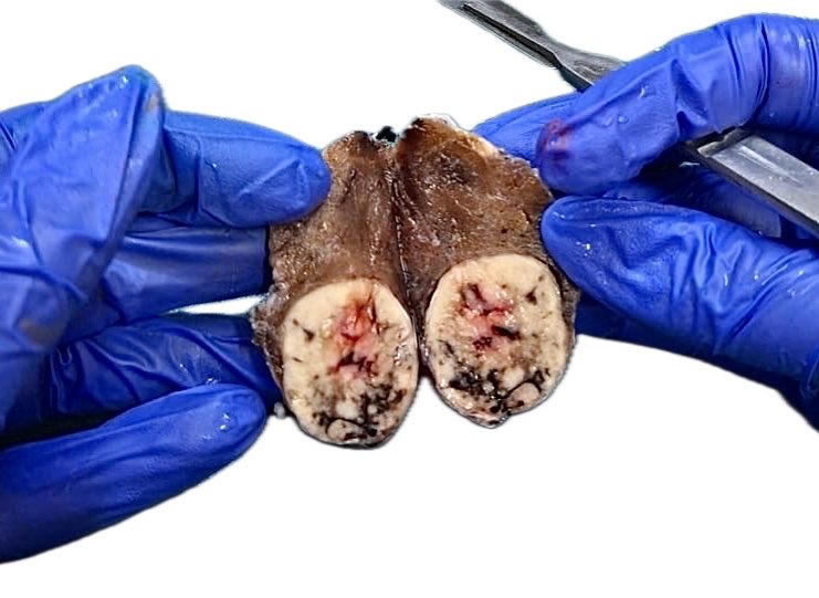 Mirror image! #Thyroid gross pathology #pathX #pathology #surgpath #endopath