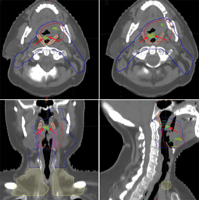Case Study: Nasopharyngeal stenosis following curative chemoradiation therapy for oropharyngeal cancer in a patient with active oral lichen Learn more ➡️ bit.ly/3Jlh9As #RadOncEd #HeadAndNeckCancer #OHANCAW #CancerAwareness #CaseStudy
