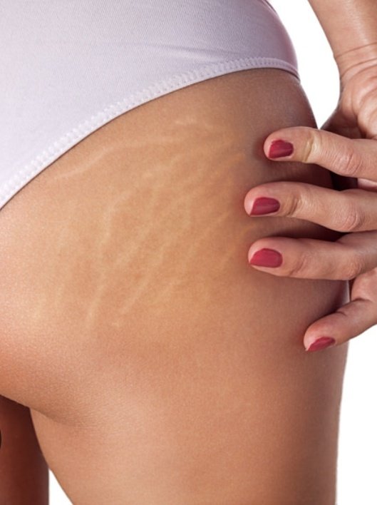 Fellas, thoughts on stretch marks?