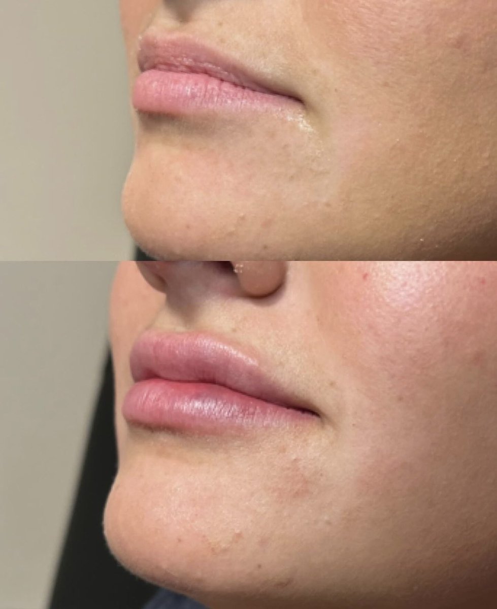 Repost @kbombaesthetics 
Kate has openings this week!! 
Visit her page to learn more about the swelling process 👄 
Call 314.725.8975 or visit faceandbodyspa.com to book your free consultation 
#nurseinjector #stlouismo #filler #healingprocess #booknow #medicalspa #stlmedspa