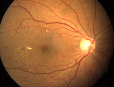 Academy of Ophthalmology Endorses Teleretinal Screening for Diabetic Retinopathy

While this modality was not as robust in detecting DME, studies show it is both accurate and cost-effective for DR.
reviewofoptometry.com/article/academ…
#diabetes #retina #diabeticretinopathy #eyecare #optometry