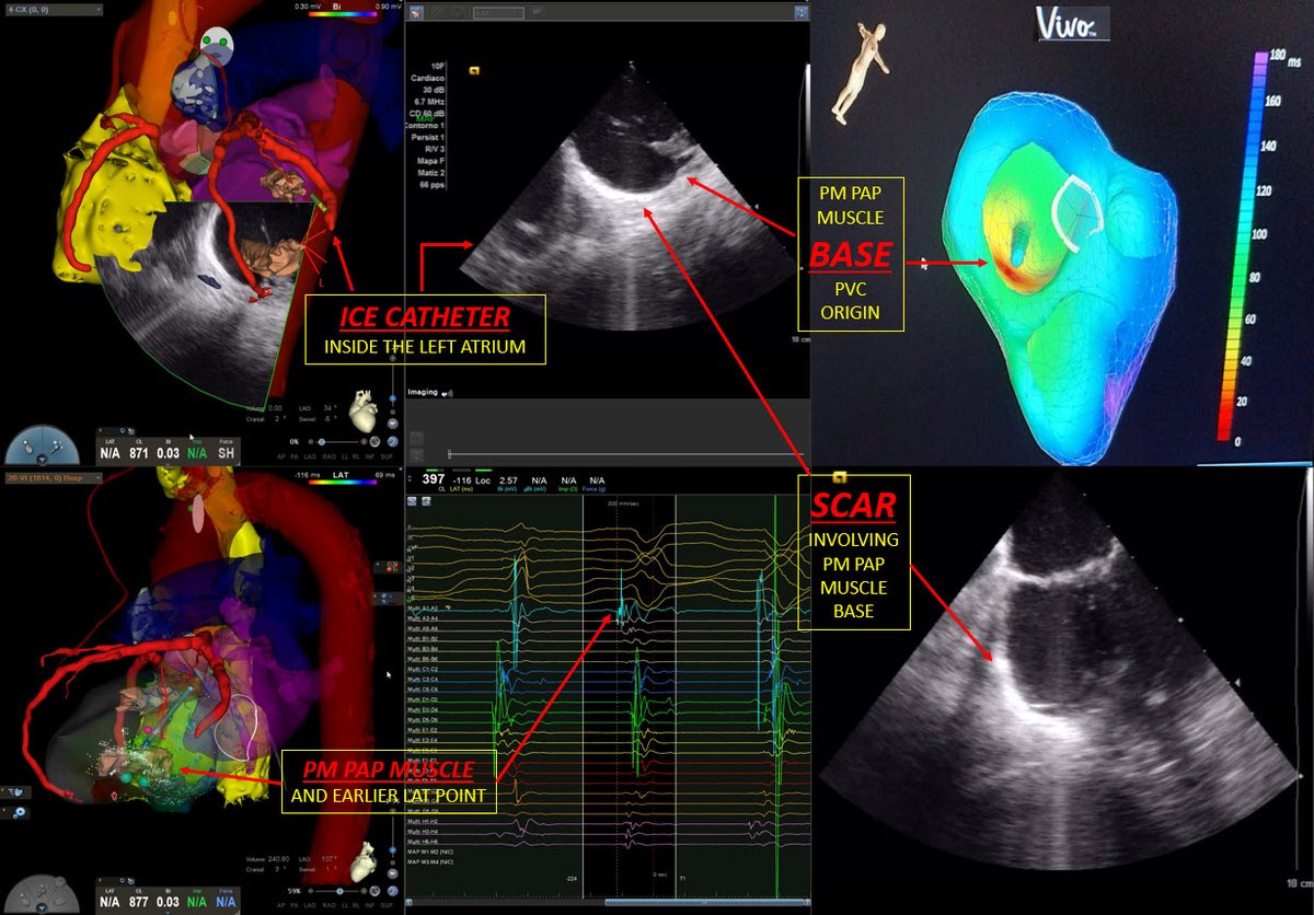 First cases in Spain using VIVO software for pap muscle PVC ablations. Integration of multimodality imaging (ICE, CT, CARTO map) played a key role in getting success in these challenging scenarios. Thanks to Catheter Precision Inc. and Biosense Webster for their support.