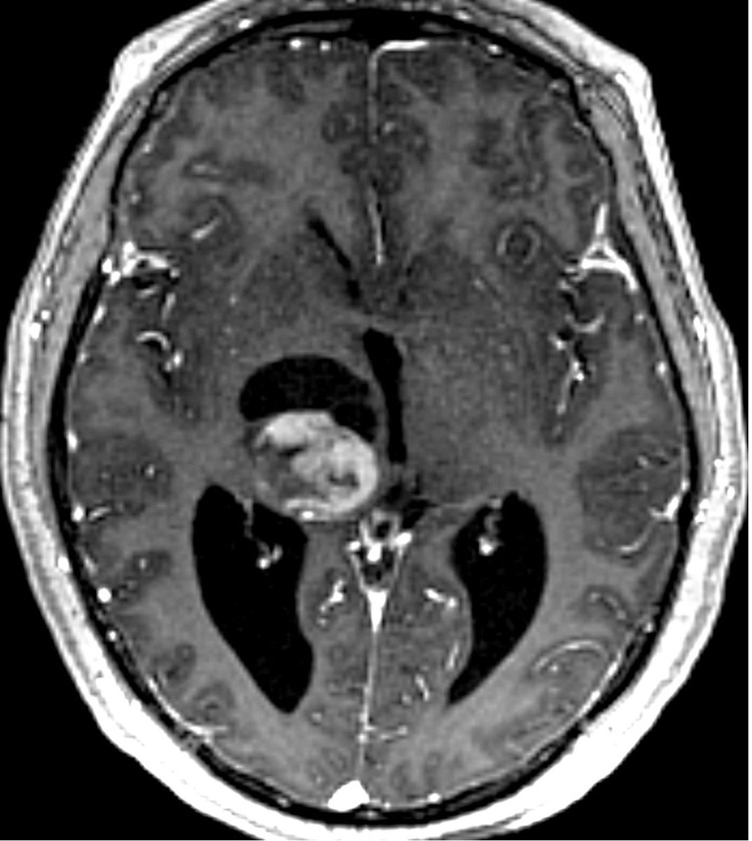 What tumor is shown in this image and how should it be treated? What are some considerations when evaluating surgical candidacy for tumors in this location? #MedTwitter #Neurosurgery #NSGY #surgery