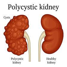 POLYCYSTIC KIDNEY DISEASE A condition where swellings (cysts) are found in the kidneys . It can affect kidney function It was not as common as the rest though. Many of them were found went the patients went for routine tests and later were then referred.