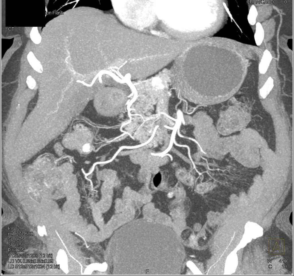 Renal Cell Carcinoma with Bowel, Pancreas and Mediastinal Metastases: ctisus.com/teachingfiles/…