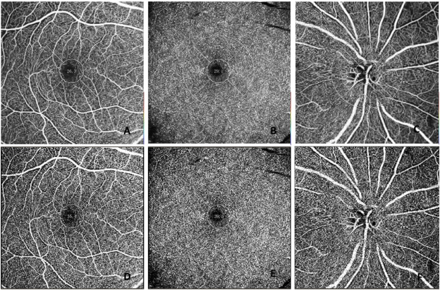 The impact of serum BNP on retinal perfusion assessed by an AI-based denoising optical coherence tomography angiography in CHD patients dlvr.it/T5bPxv