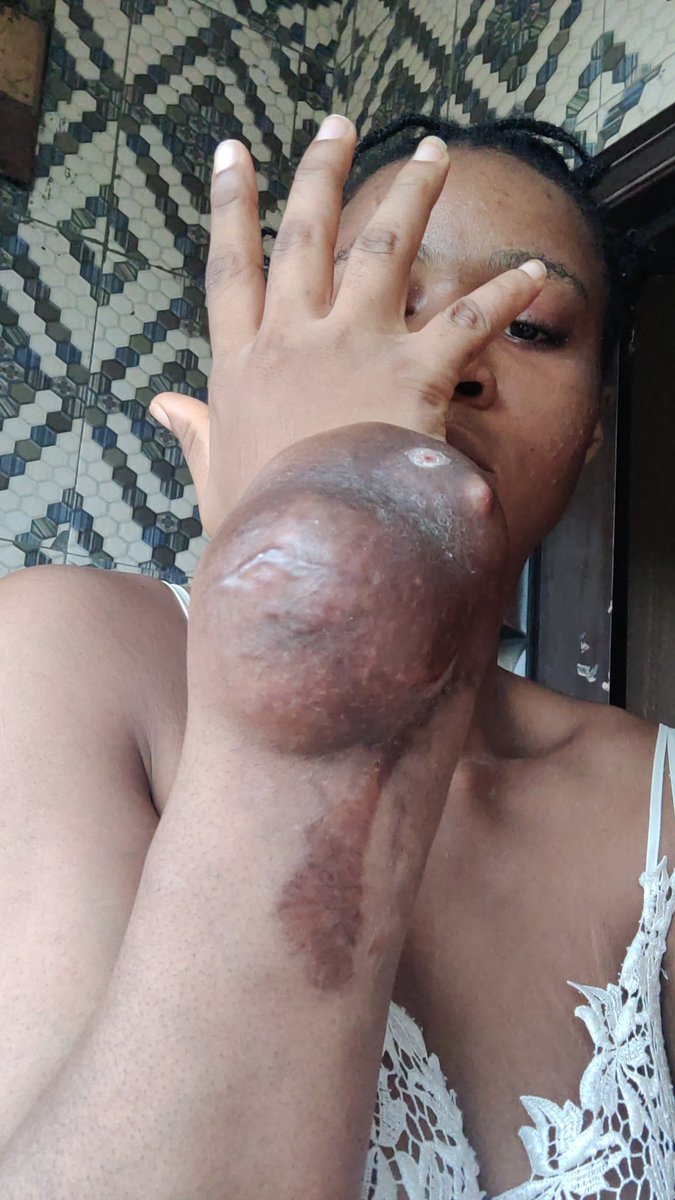 ms_ebi_'s tweet image. Guys my doctors.tols me today that it&apos;s spreading and eating on my bones.. I have cried my eyes out , I don&apos;t know what exactly to do at this point cause I don&apos;t think I can afford this treatment.

This cancer is winning , guys help 😭😭😭
The little hope I have is Gone 😭
