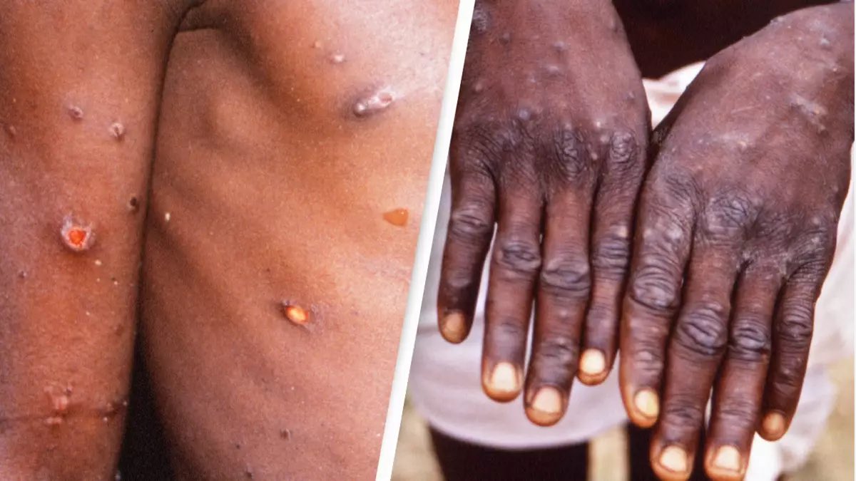 🚨 JUST IN: A “mutant strain” of Monkeypox—supposedly with “pandemic potential”— has been located in a Congo town Health officials are now calling for “URGENT MEASURES” to contain it. Gee, it’s a good thing we aren’t dumping millions of unvetted illegal African migrants into