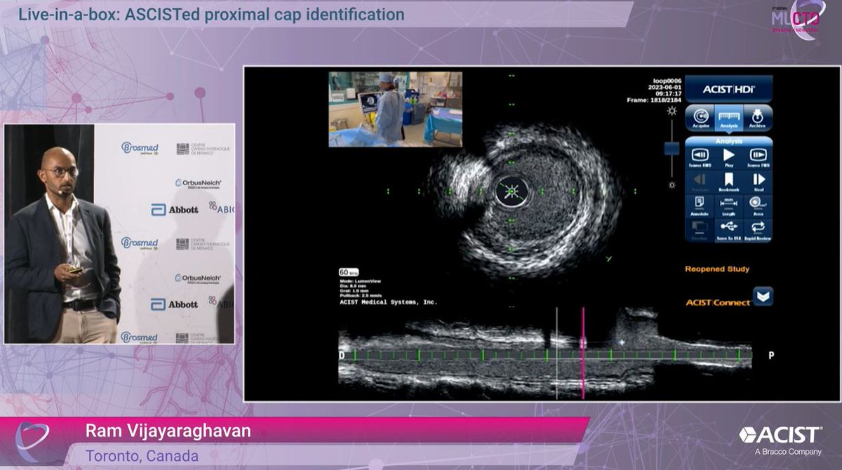 #ICYMI watch this case study during #MLCTO 2023 in which Dr Ram Vijayaraghavan from Scarborough Health Network in Toronto (Canada), explains how IVUS can assist physicians with the identification of the Proximal Cap in #CTO #PCI procedures.

buff.ly/3xIerT6