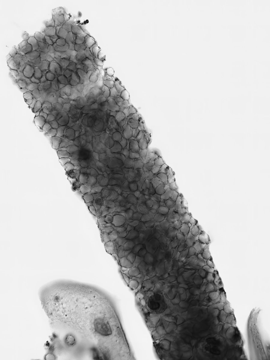 RBC cast (also contains a couple WBCs) - brightfield with SM stain - converted to grayscale - #UrinarySediment #UrineMicroscopy