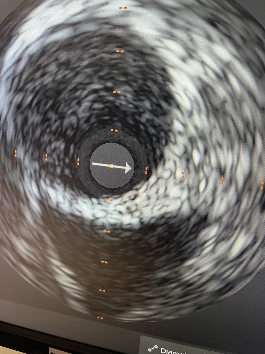 #imagefirst A little pop quiz with IVUS. What is the structure seen outside of the prox LCA at 6 o’clock called?