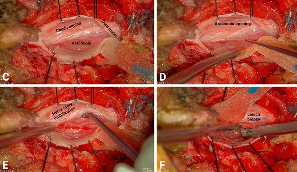 ARODMDPHD's tweet photo. Our new paper is out on a rare case of extramedullary primary spinal cord #Glioblastoma.  Congrats @wjshelton  and team! We used the #aesculap exoscope for this case and got beautiful intraop pics. https://t.co/LZHowX1REX https://t.co/cTE7Ys9jmZ
