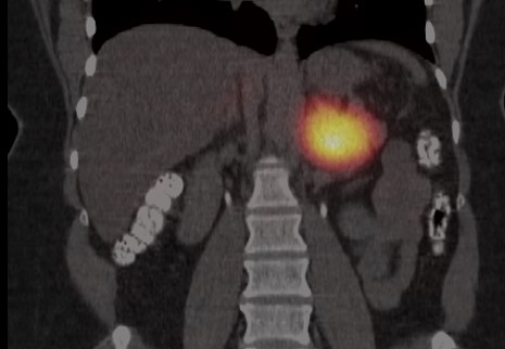 Pheochromocytomas - rare adrenal tumors that produce too much of the 'flight or fight' hormones - can be caused by an inherited diseases including von Hippel Lindau, MEN 2, neurofibromatosis, and SDH mutations. @NADF_Adrenal @TheAACE @TheEndoSociety