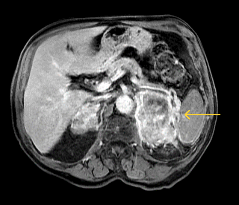 Adrenocortical carcinoma (ACC) is a rare cancer that has been reported to have an incidence between 0.5 - 2 cases per million population per year. @NADF_Adrenal @TheAACE @TheEndoSociety