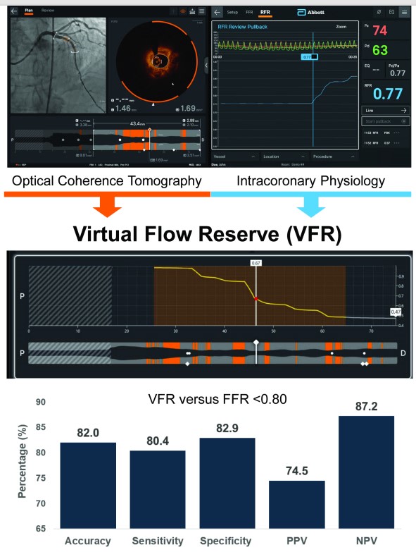 OCT-based functional stenosis assessment. Imaging derived physiology to assess the significance of intermediate coronary stenosis @wfearonmd @ziadalinyc @DrAllenJ @BuccolaJana #cardiotitter #AHAJournals ahajournals.org/doi/abs/10.116…