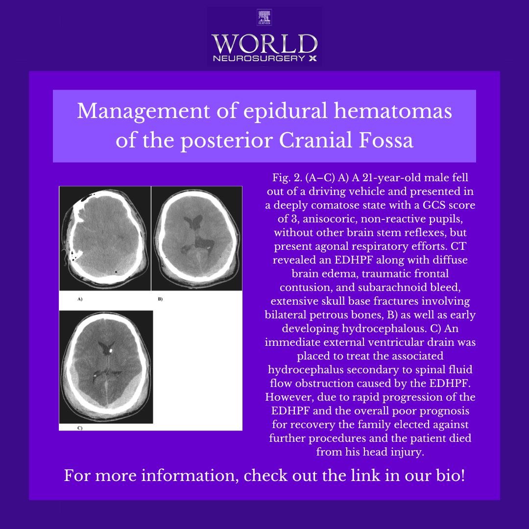 WorldNSX's tweet photo. 🧠 The majority of EDHPF can be treated safely with conservative management. Measures to avoid an increase in intracranial venous pressures are key to success in conservative therapy. Indications for surgical evacuation should be considered on an individual basis. https://t.co/zAZrUEwCeq
