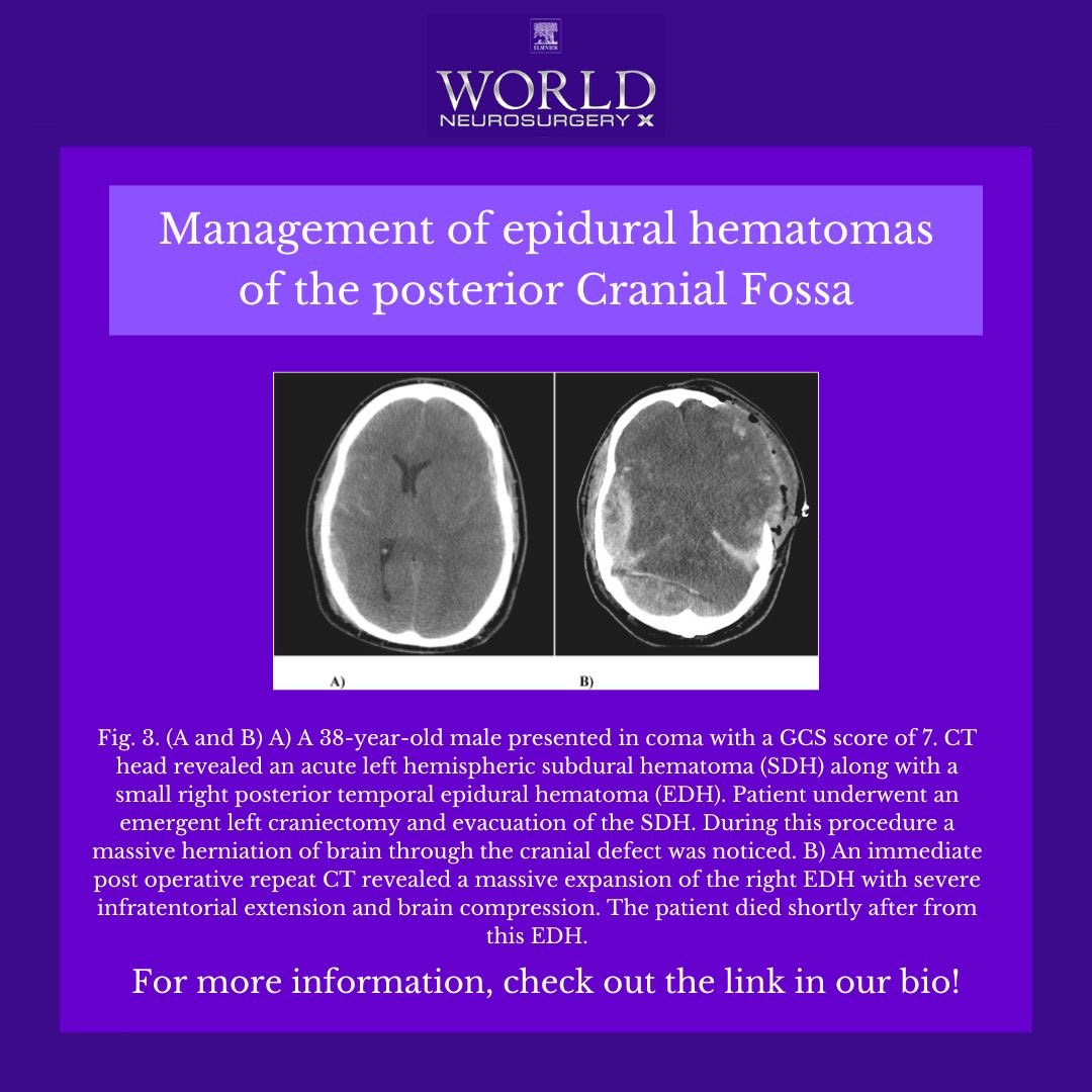 WorldNSX's tweet photo. 🧠 The majority of EDHPF can be treated safely with conservative management. Measures to avoid an increase in intracranial venous pressures are key to success in conservative therapy. Indications for surgical evacuation should be considered on an individual basis. https://t.co/zAZrUEwCeq