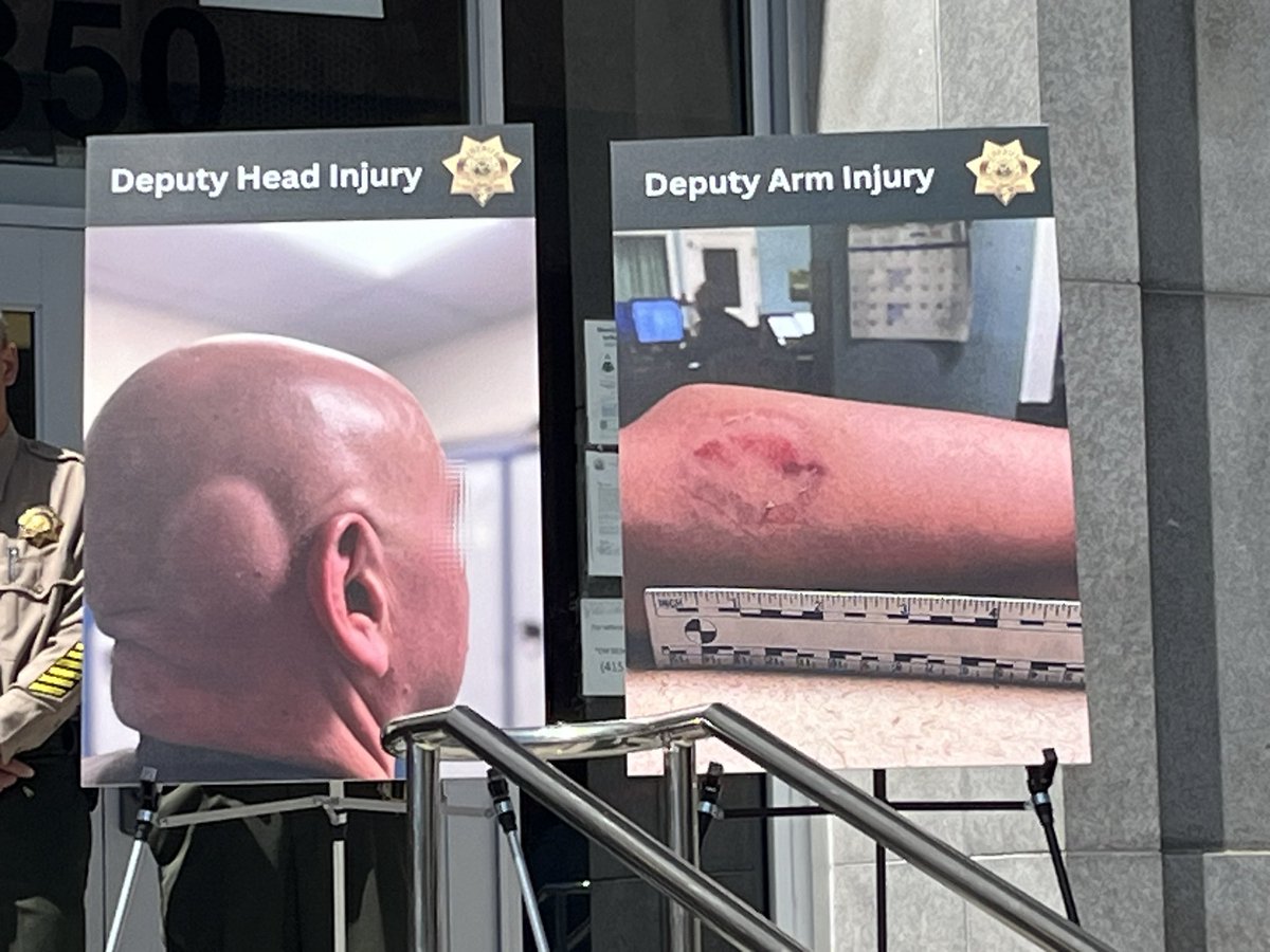 Two jails in SF county continue to be on lockdown after a series of assaults on @SheriffSF deputies. Sheriff Miyamoto say some of the injuries include: head injuries, bites to the arm, dislocated shoulders, bone fractures and eye injuries. @nbcbayarea