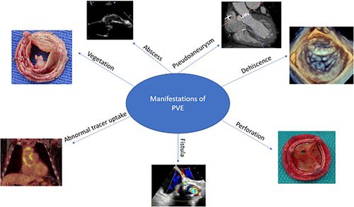 In this review, we aim to characterize the manifestations of prosthetic valve endocarditis using representative case studies from @ClevelandClinic to highlight the advances & contributions of modern multimodality imaging techniques. ➡️ ahajournals.org/doi/10.1161/CI…