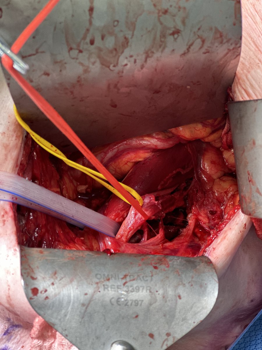 Femoral Nerve Schwannoma before and after resection . 

Well preserved , full postoperative ROM 

#surgonc #gensurg