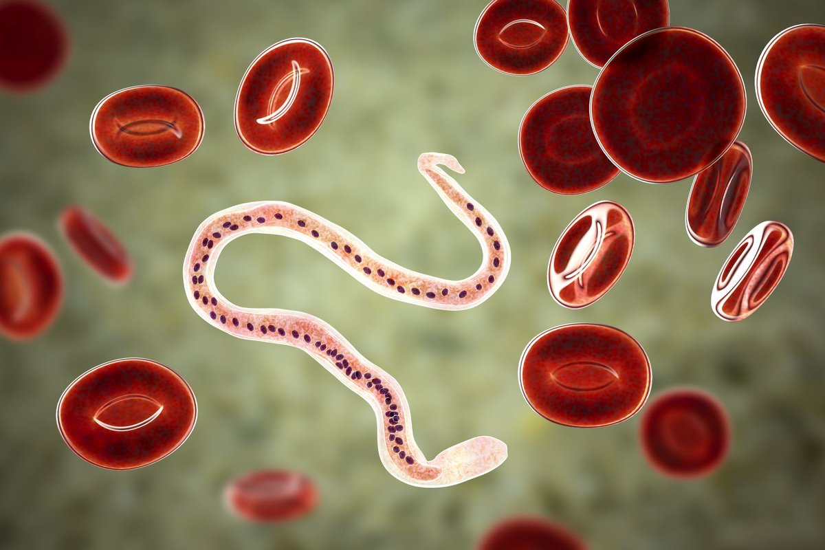 DannyD21100's tweet photo. 1/ Lymphatic filariasis is a neglected tropical disease caused by parasitic worms, mainly  Wuchereria bancrofti, Brugia malayi, and Brugia timori. #Microbiology #Parasitology #LymphaticFilariasis
#LearmWithD2 https://t.co/YCSxA5sPir