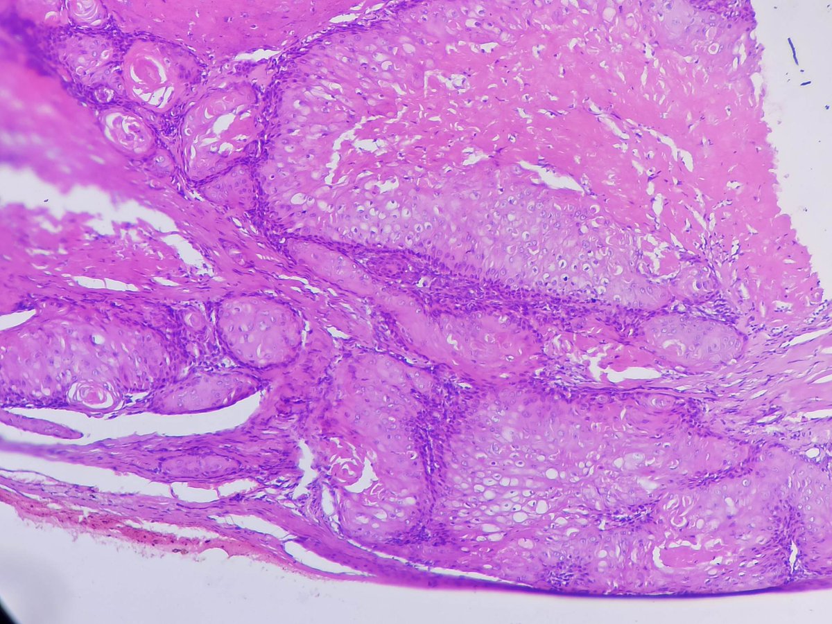 40 yr lady with scalp swelling in parietal region. A nice example of proliferating pilar tumor (grade group 1) featuring lobules of squamous epithelium with trichilemmal type keratinization. #pathology #dermpath