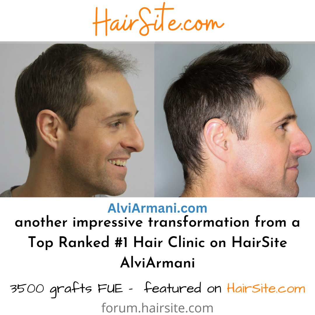 sponsored - hair restoration from the no 1 #top ranked #hair clinic in the #US - #free consultation and cost estimates at bit.ly/3VQc8n3 #trending #trendingnow #kpop #NASCAR #BTSARMY #tiktok #bitcoin #NFT #2024 #election #news #dailynews #losangeles #beverlyhills