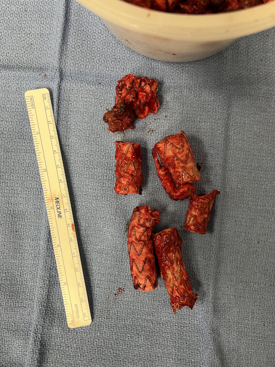 At this rate we will take out more endografts than we put in this year. Anyone else noticing a similar trend? Is the pendulum swinging? This one for a type Ia endoleak 5 years after EVAR for rAAA. #inthebucket #aortaed