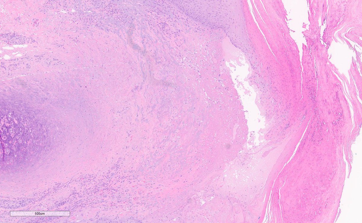 Chondrodermatitis nodularis helicis.

Lesion of auricle.

🔬

Epidermal central ulceration w/ adjacent acanthosis, hyperkeratosis, parakeratosis, pseudoepitheliomatous hyperplasia.

Ulcer base w/ granulation tissue involving cartilage.
+/- Fibrinoid necrosis
Absent normal adnexa