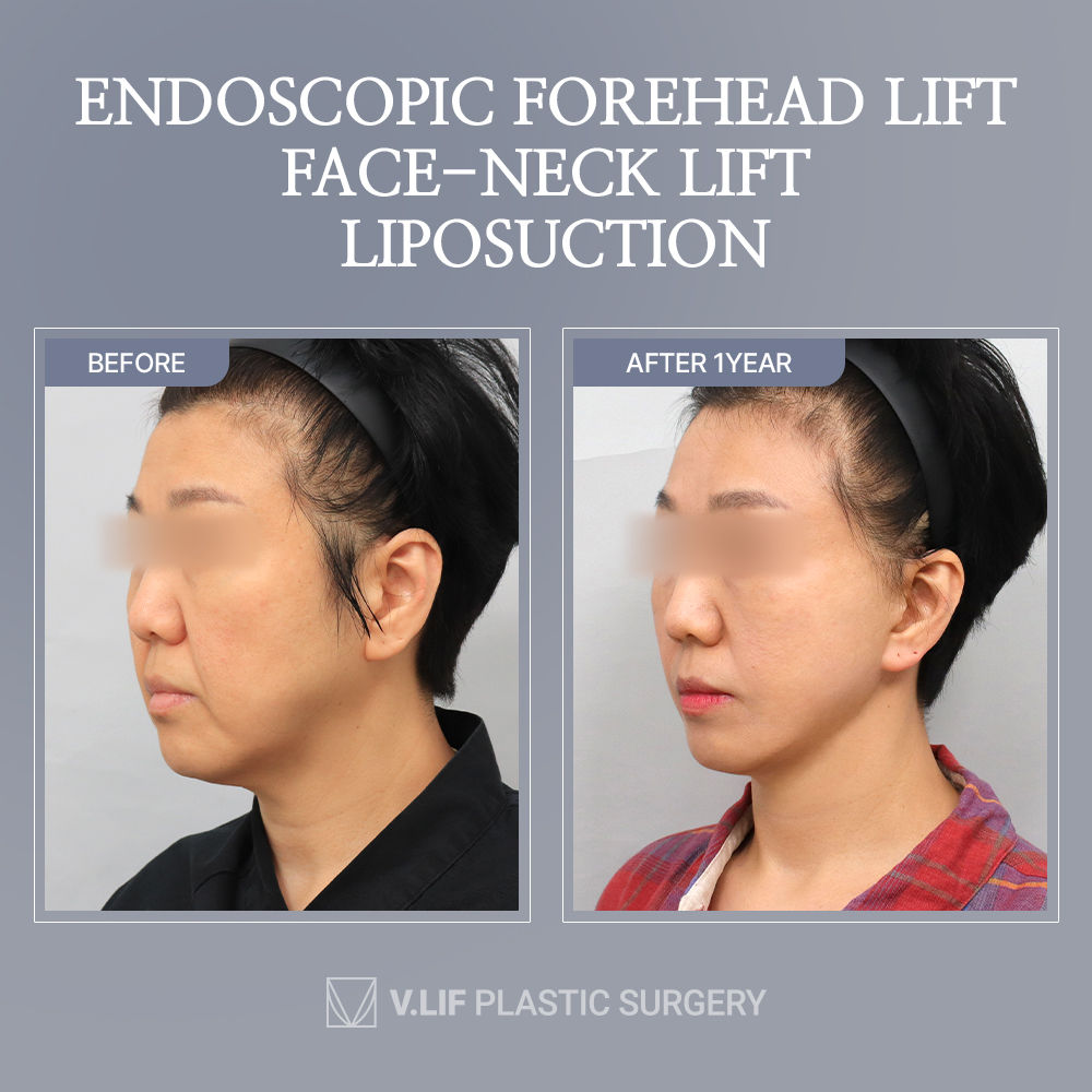 ❤️After 1year of the surgery ! can you see the differences?❤️#facelift

#facelift #necklift #liposuction #looseskin #skintightening #facialplasticsurgery #antiwrinkle #antiaging #SMAS #droopy #jowls  #doublechin #koreabeauty #koreacosmetic #aestheticsurgery #vlifplasticsurgery