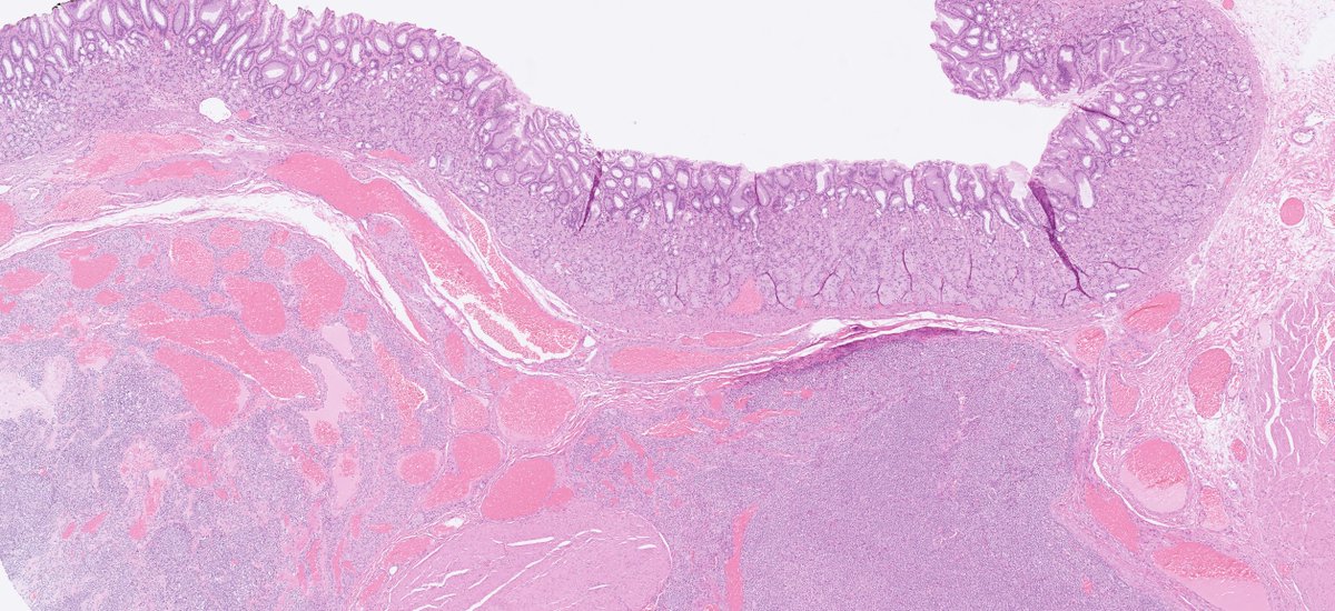 DrJuhlin's tweet image. 70ish y/o male, gastric lesion, excision. Tumor is locaded in the submucosa, with infiltrative growth to the subserosal layer. Cells are arranged in solid sheets. Monomorphic appearance. Let's have a closer look! Follow the thread... 🧵