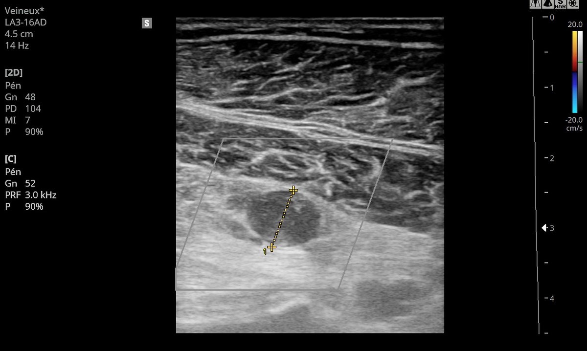 Ah je viens d'avoir en patient que je ne connais pas, H47 IAA il y a 3 jours, chute, va aux urgences --> aurait #tête fibulaire. En écho corticale régulière, plainte mollet un peu sensible mais cliniquement rien.