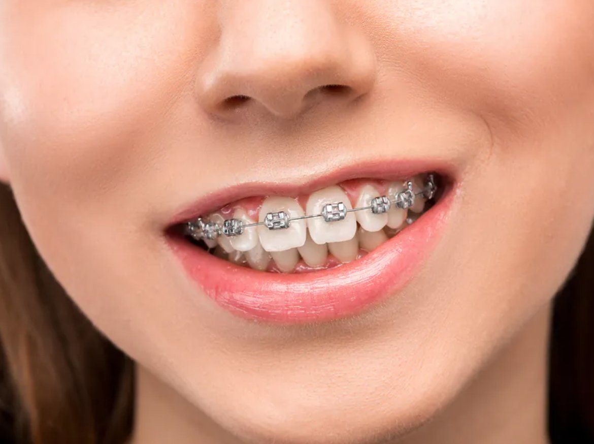 dentistnearyou's tweet image. How to Fix an Overbite suredental.com.au/how-to-fix-an-… #fixoverbite #orthodontics #overbite #dentistry #brisbane #dentist #brisbanedentists #wavellheights #chermside