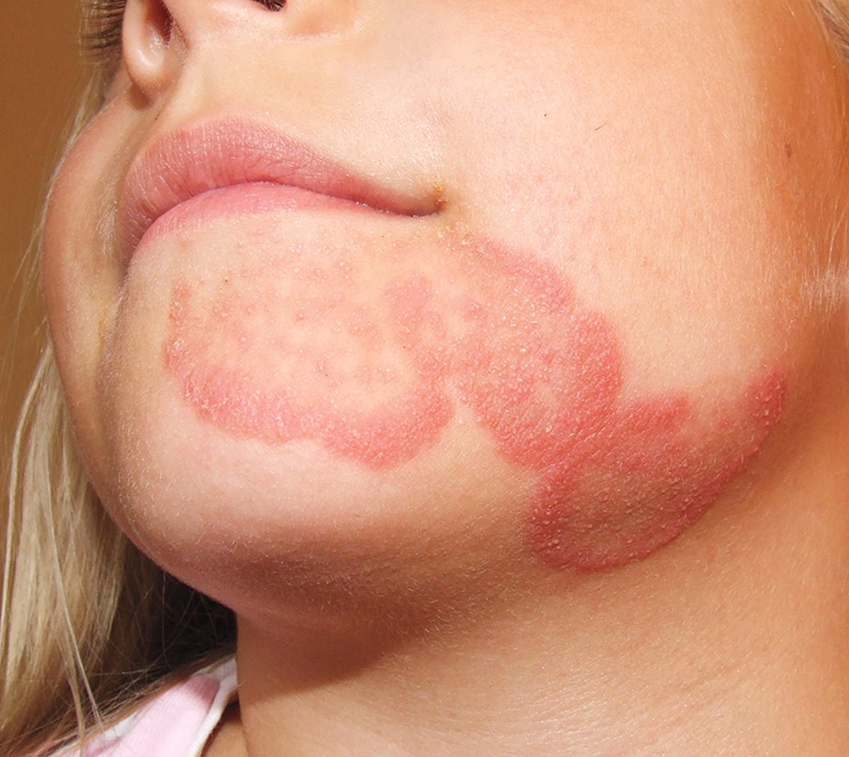 A healthy 5 y/o girl presented with dry, scaly, erythematous, and annular lesions on her face. - What’s the Diagnosis ? ➡️ Full Case and Answer: manualofmedicine.com/spot-diagnosis… #medtwitter #foamed #usmle