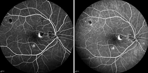 White Dot Syndromes: Report of Three Cases 

➡️ ow.ly/58pW50R3Zsc
✍️ Olazaran L. et al.  
📖 #CaseRepOphthalmol 

#OpenAccess