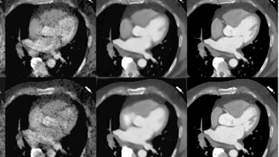 #DeepLearning-based 3D denoising of dose-modulated cardiac CTA doi.org/10.1148/ryai.2… @StanfordRad @MarinaCodari @Mastrodicasa_MD #CVIRad #SyntheticData #heart