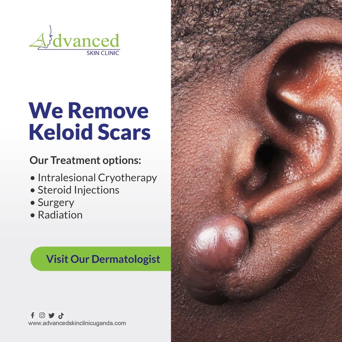 Keloid & Hypertrophic Scars. The treatment is determined based on the size, location, and symptoms of the keloid. Call us on 0755562430 for treatment Visit our website: advancedskinclinicuganda.com/scar-treatment/