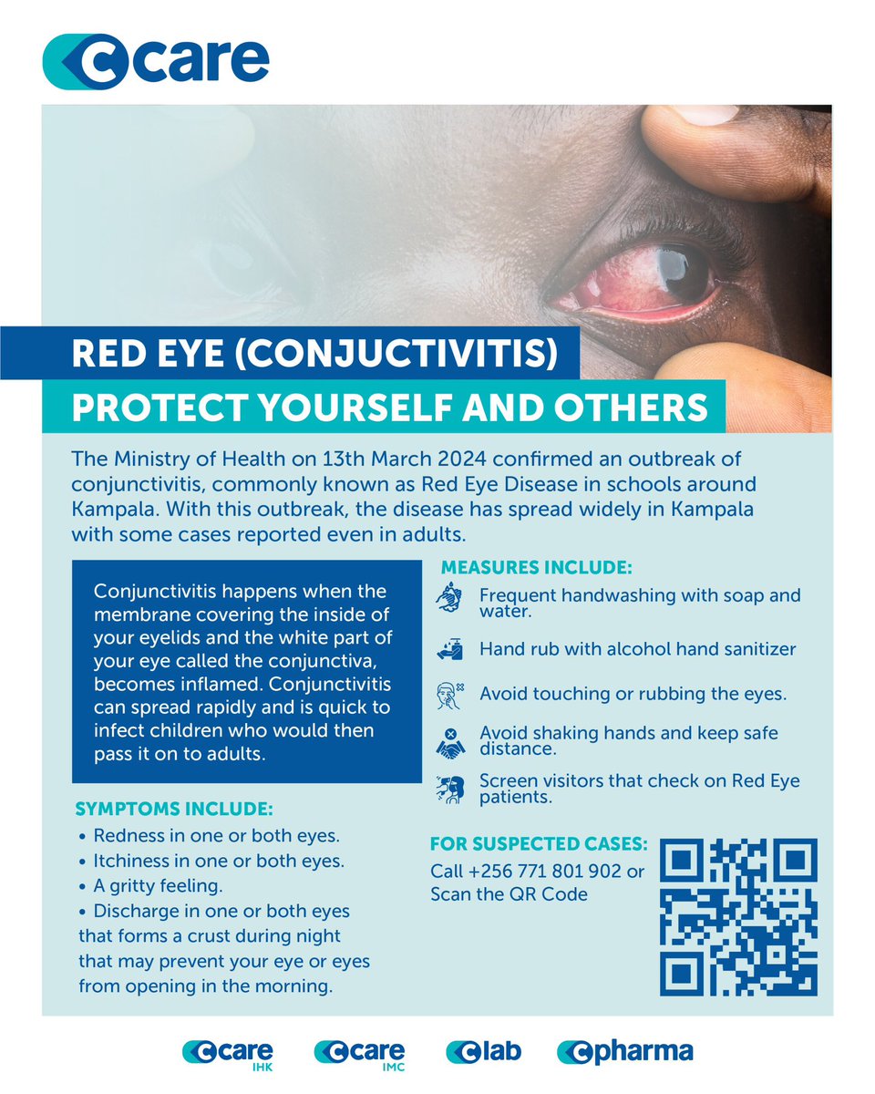 STAY ALERT‼️ 

Theres’ an outbreak of conjunctivitis or red eye disease in Kampala. 

Follow these preventive measures to protect yourself and others from this highly contagious illness.

Report any suspected cases immediately.
c-care.com/ug/
#CCareWellness #BigOnCare