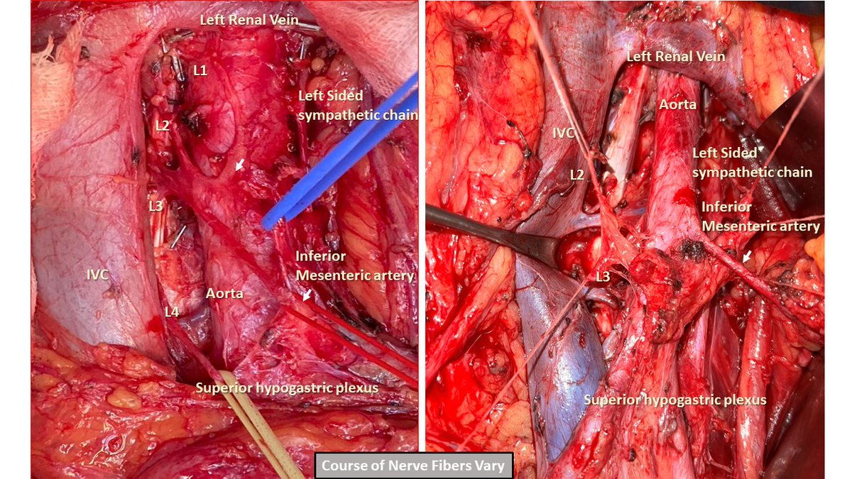 TCa D 17
Absence of Antegrade Ejaculation causes greatest  Psycho- Social influence on testicular cancer survivors.
Maintaining Antegrade Ejaculation by Nerve- Sparing RPLND may help to overcome it in upto 95 %of patients.......