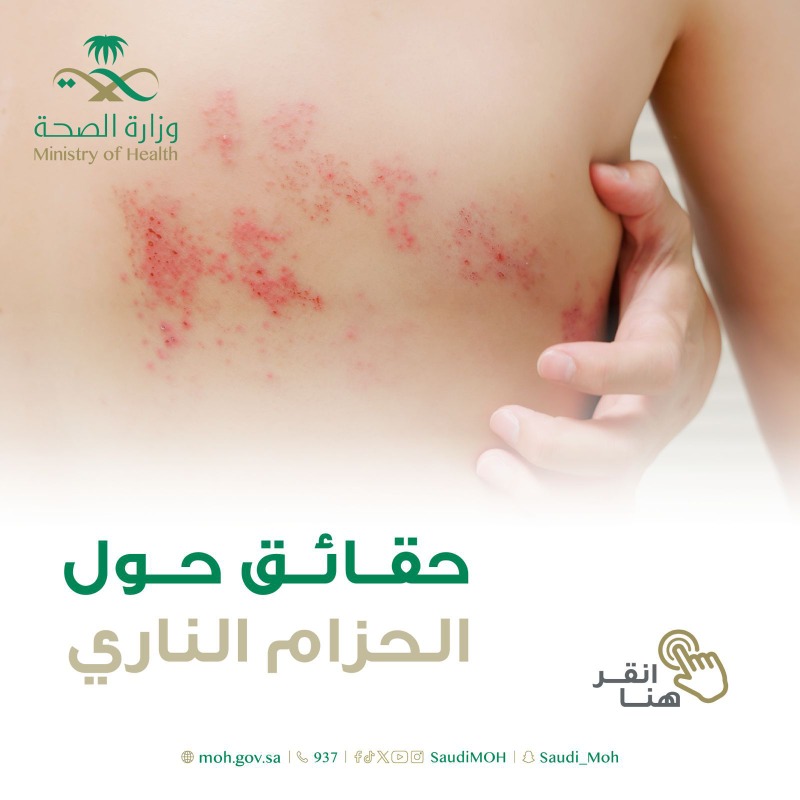SaudiMOH's tweet photo. ما هو مرض الحزام الناري وكيف يمكن علاجه؟
 للمزيد من المعلومات ⬇️